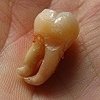 Wisdom tooth